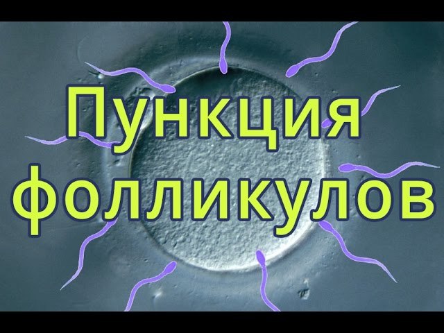 Пункция фолликулов (яйцеклеток) при ЭКО: забор яйцеклеток, диета до и после