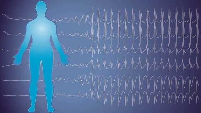 Приступ эпилепсии у человека: причины, симптомы, лечение
