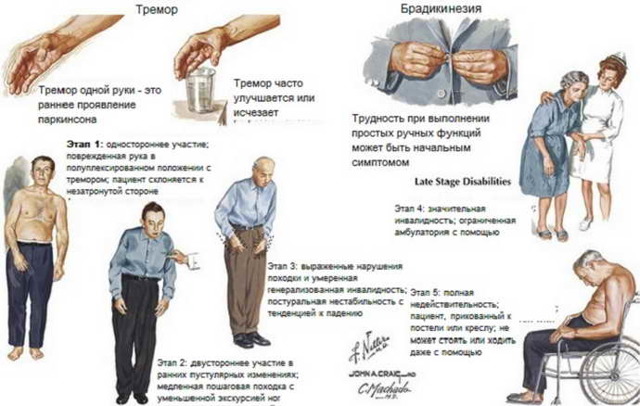Общее и отличия Паркинсонизма и болезни Паркинсона