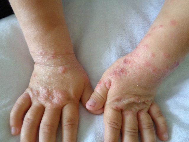 Дерматит у ребенка на руках: фото, причины, симптомы, лечение