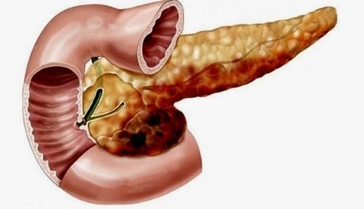 Панкреонекроз поджелудочной железы: прогноз после операции, последствия, летальный исход