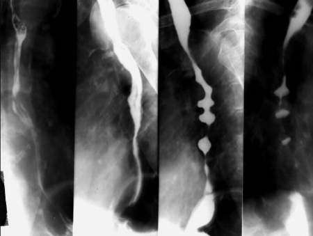 Рентген желудка с барием и подготовка к нему пациента: как делают и что показывает, последствия и вывод из организма контрастного вещества после рентгеноскопии