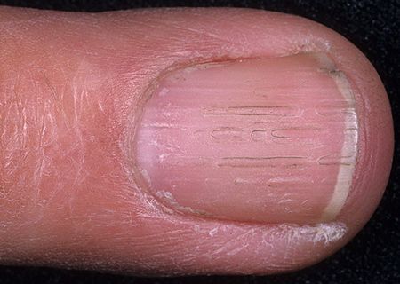Продольные полосы на ногтях: причины и методы лечения