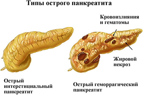 Диета при остром панкреатите - питание и рецепты