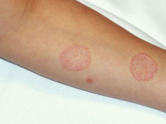 Кожные болезни кожи у человека – фото и название, лишай, дерматит, чесотка, лечение