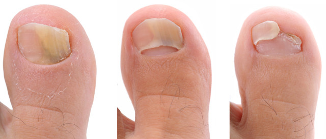 Отслоение ногтя на большом пальце ноги: лечение и профилактика