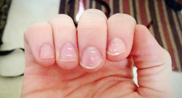 Белые пятна на ногтях пальцев рук, причина и лечение