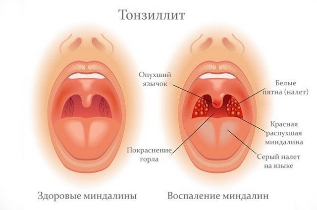 Как проявляется и лечится кандидоз миндалин?