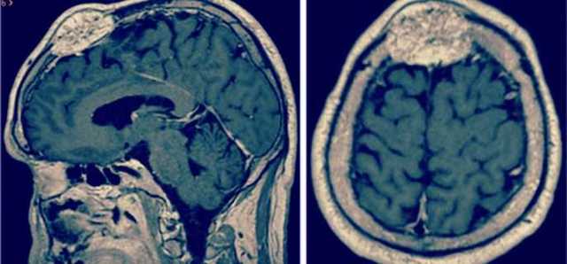 Чем вызвана менингиома головного мозга - причины, симптомы, лечение
