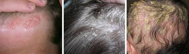 Cеборея кожи головы лечение в домашних условиях, фото