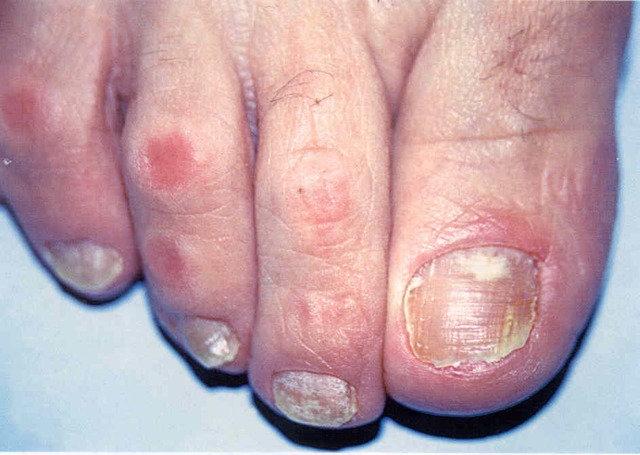 Яблочный уксус от грибка ногтей на ногах: лечение, отзывы