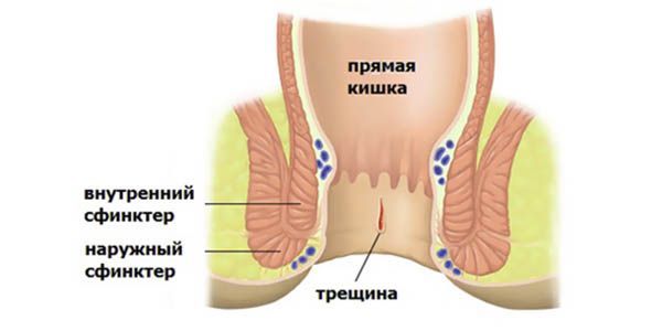 Понос с кровью у взрослого: причины, симптомы и лечение