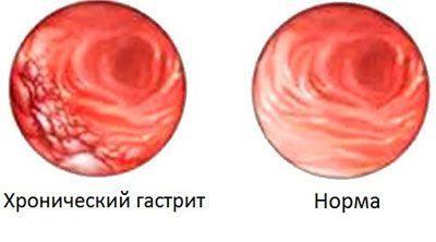 Режущая боль в желудке: что делать при резях, причины и лечение заболеваний