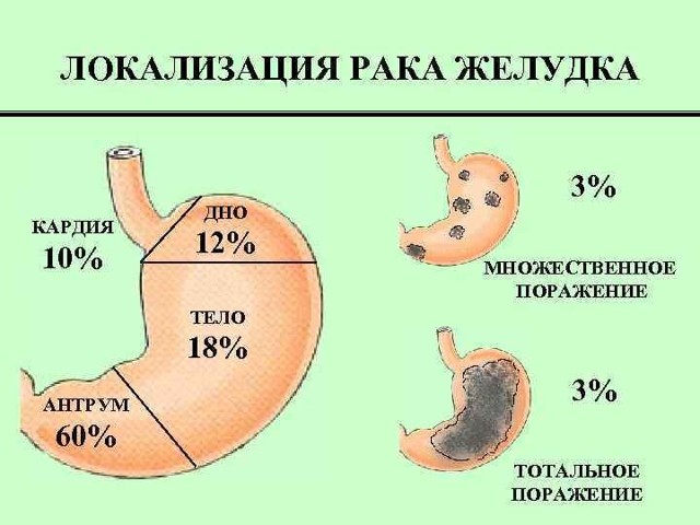 Рак желудка: первые симптомы и поздние признаки, лечение и прогноз