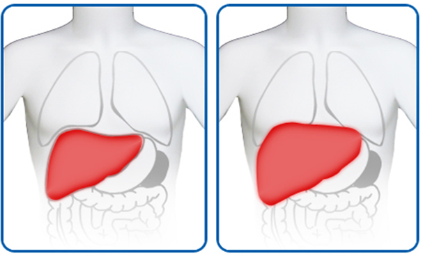 Гепатомегалия печени: что это такое, признаки, лечение препаратами