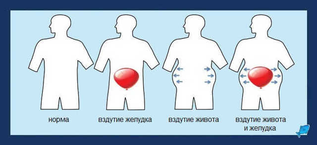 Что помогает от вздутия живота: лекарства, таблетки, препараты